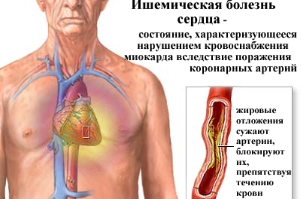 Курение как причина ишемической болезни сердца
