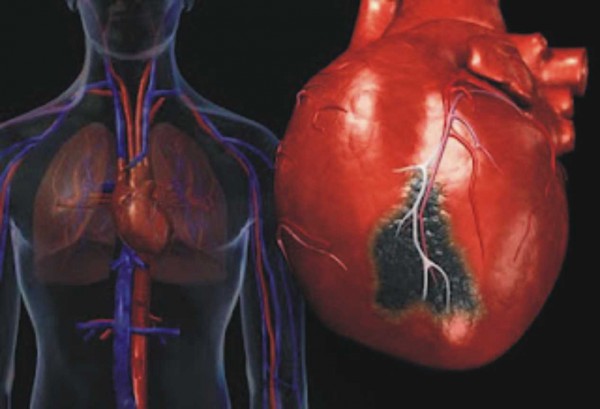 Курение как причина ишемической болезни сердца
