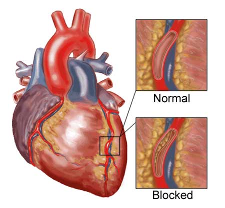 Курение как причина ишемической болезни сердца thumbnail